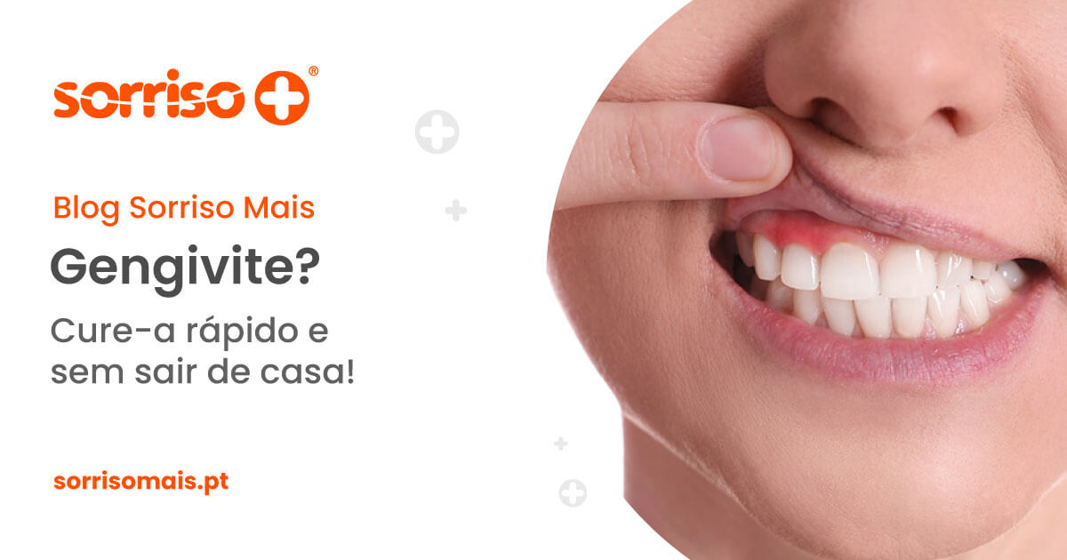 Como curar gengivite rápido e sem sair de casa? - Sorriso Mais