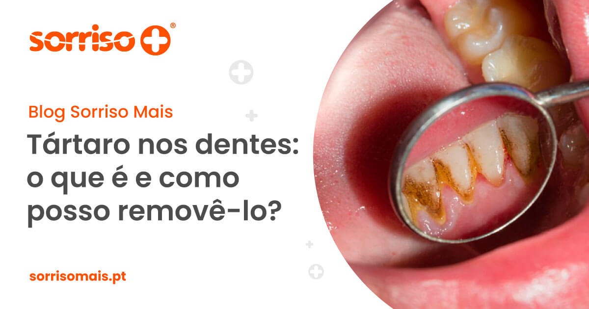 Tártaro nos dentes: o que é e como posso removê-lo? - Sorriso Mais