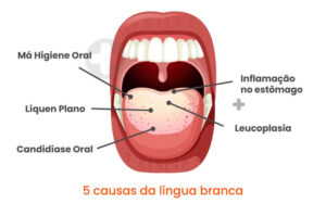 5 causas da língua branca e como a evitar - Sorriso Mais