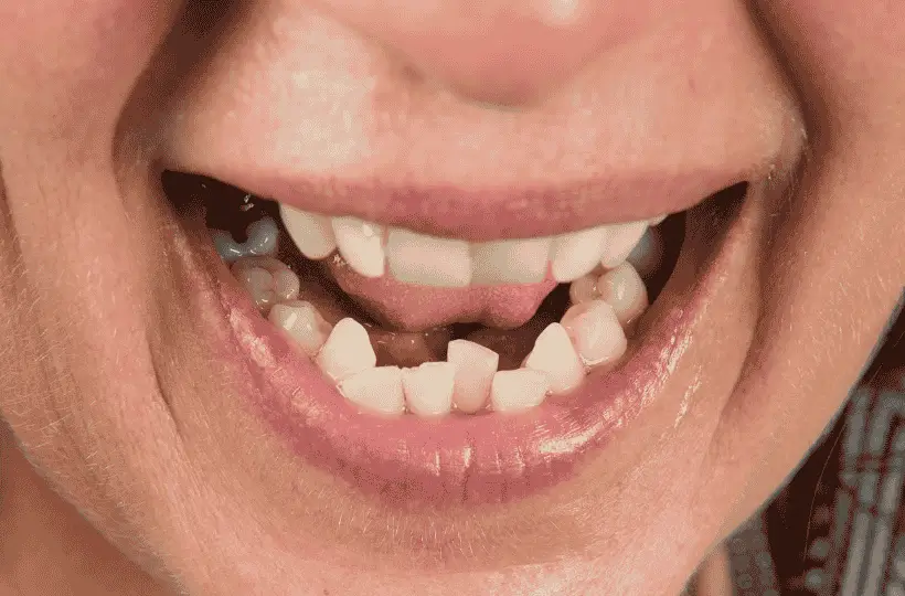 Aparelho Dentário: os dentes podem voltar a entortar?