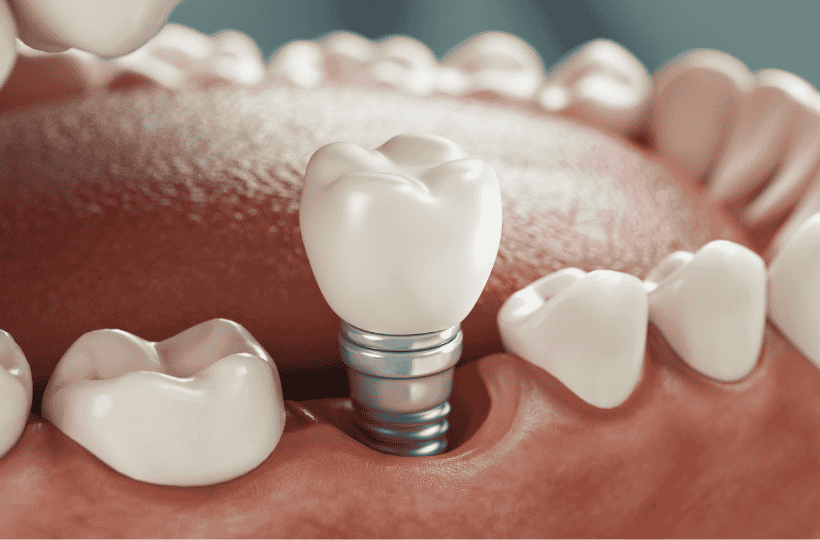 Implante Dentário: quais os riscos e como evitá-los?