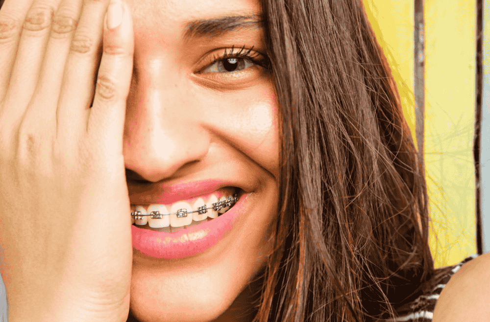 Posso fazer branqueamento dentário com aparelho?