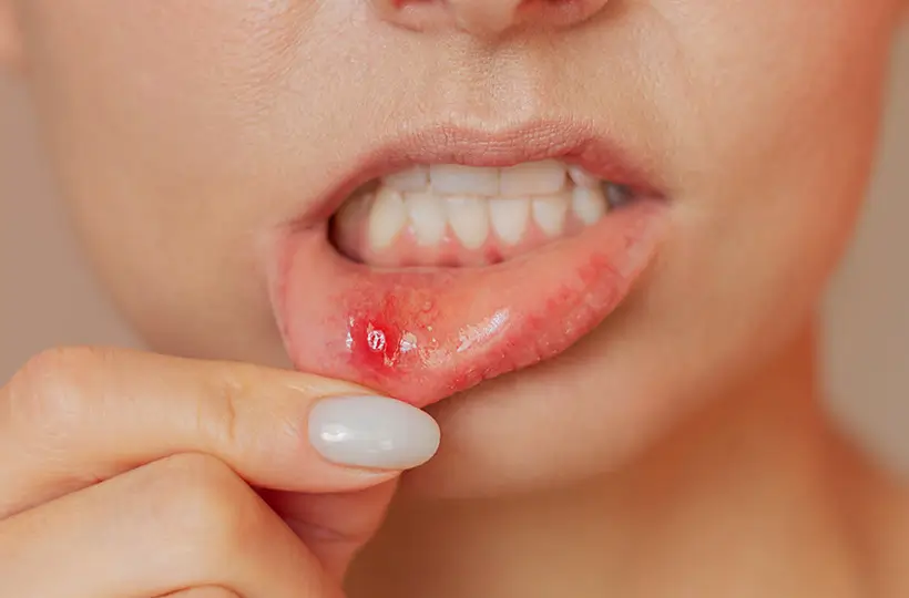 Aftas no Inverno: porque aparecem mais e como aliviar