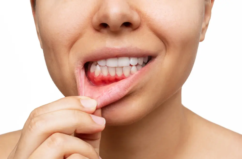 Gengivite vs periodontite: sinais de alerta, diferenças e como prevenir